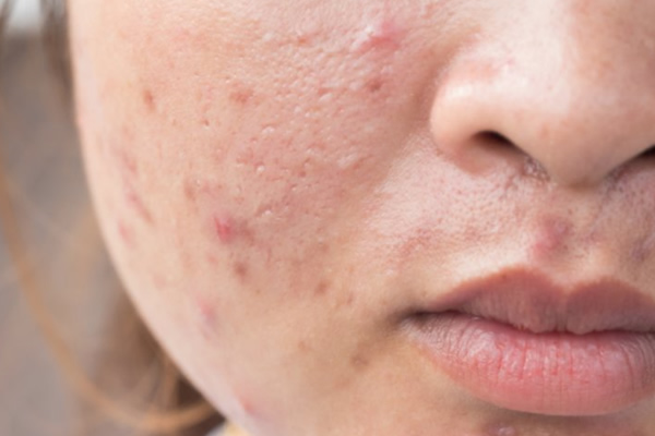 Acne and pimple wellness consultation at Dhanvanthri Clinic, Karaikudi