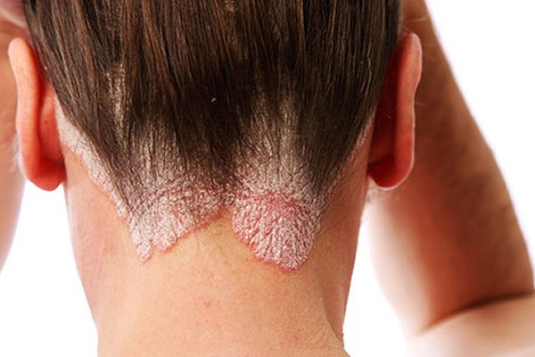 best psoriasis ayurvedic doctor in chennai, 
psoriasis ayurvedic doctor chennai, 
best ayurvedic doctor for psoriasis in chennai, 
ayurvedic doctors in chennai, 
best ayurvedic clinic in chennai, 
ayurvedic doctor for psoriasis in chennai, 
siddha clinic, 
ayurveda clinic chennai, 
best ayurvedic hospital for psoriasis in chennai, Psoriasis Treatment In Tamil Nadu,Psoriasis Doctor In Chennai, Psoriasis Specialist In Chennai, Psoriasis Treatment In Chennai, Psoriasis Treatments In Chennai, Psoriasis Hospital In Chennai