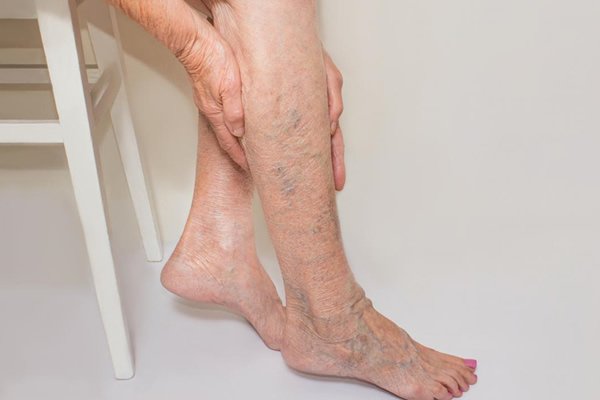 Ayurvedic treatment for Varicose Veins in Chennai