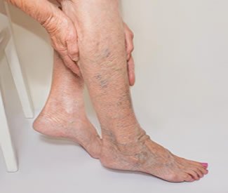 Ayurvedic treatment for Varicose Veins in Chennai